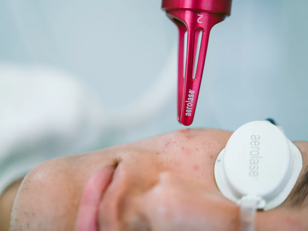 Tratamiento de manchas faciales con láser Aerolase en Lum Clinic, Sant Cugat